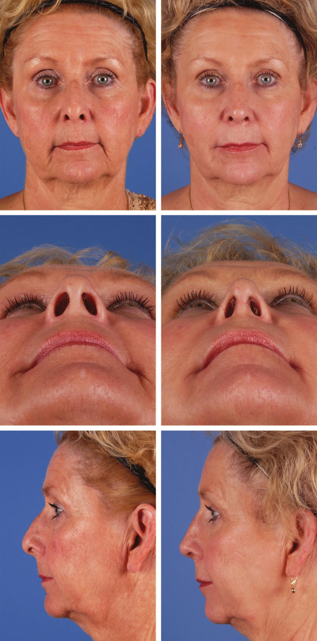 Plastic and Reconstructive Surgery October 2012 Fig. 2. Case1: agingnose.