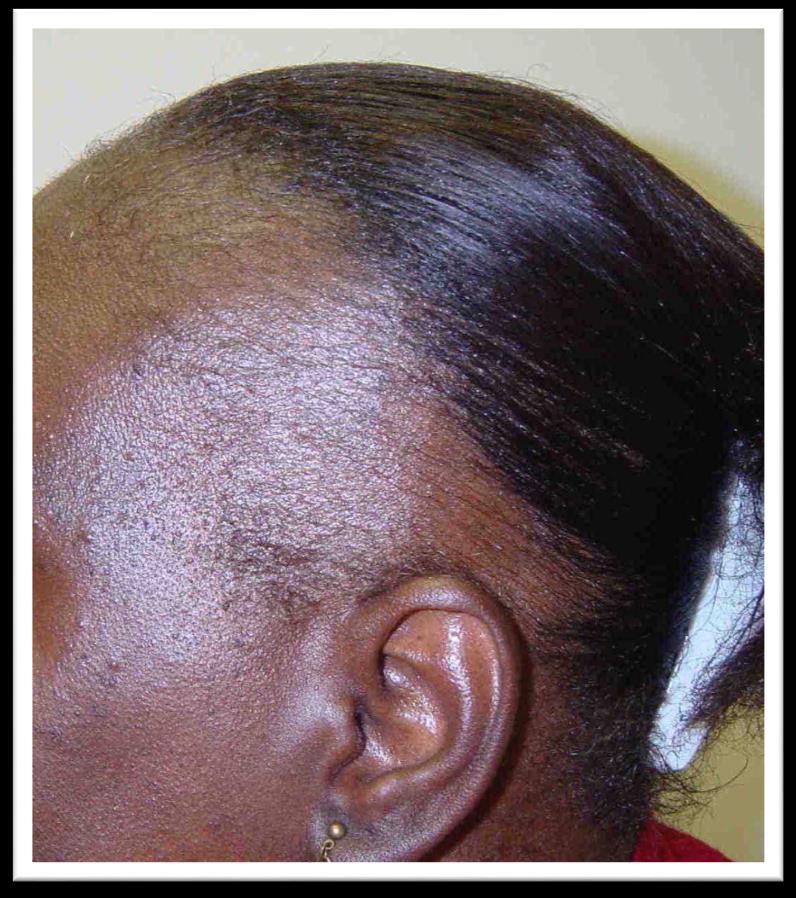 Traction Alopecia Which hairstyle is associated with the highest risk of traction alopecia: A.