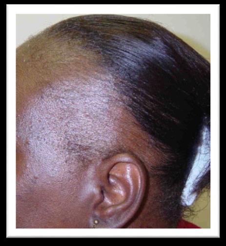 Traction Alopecia Risk factors Traction (braids/weaves) on relaxed hair (OR 3.47) Hair dressing symptoms-highest was tight braids that caused pimples (OR1.