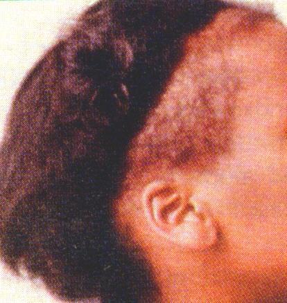 Traction Alopecia Traction alopecia is preventable