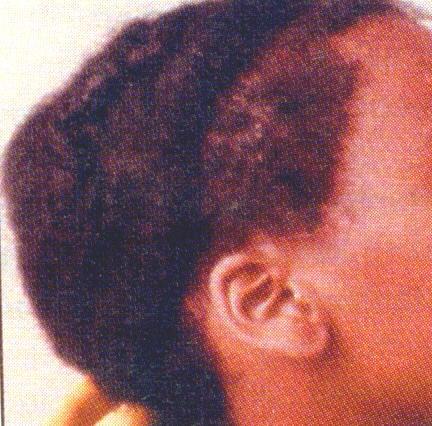 avoid tight hairstyles Treat with topical steroids