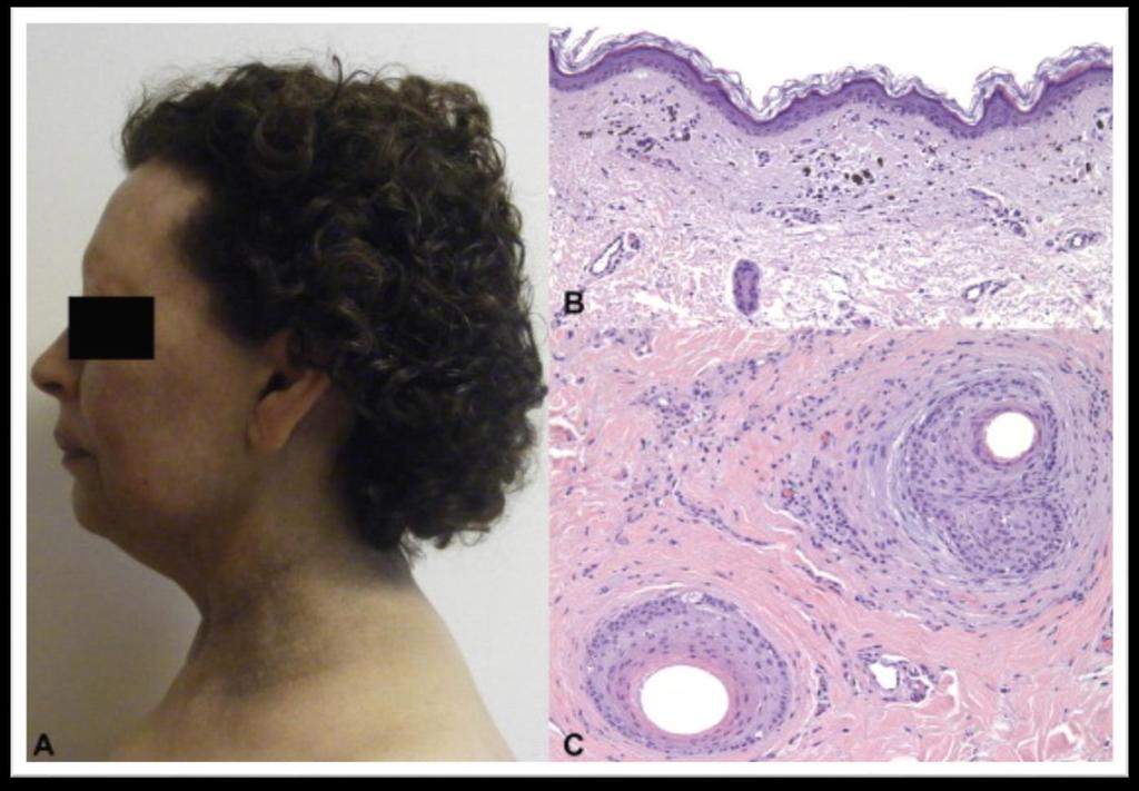 Frontal Fibrosing Alopecia associated with Lichen Planopilaris A, Lichen planus pigmentosus and frontal fibrosing alopecia.