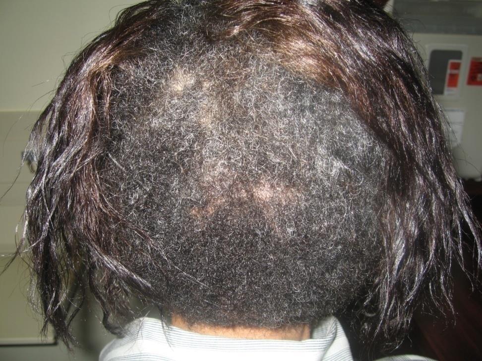 Acquired Trichorrhexis Nodosa Breakage Relaxers can cause superficial, self-limited chemical burns to the scalp