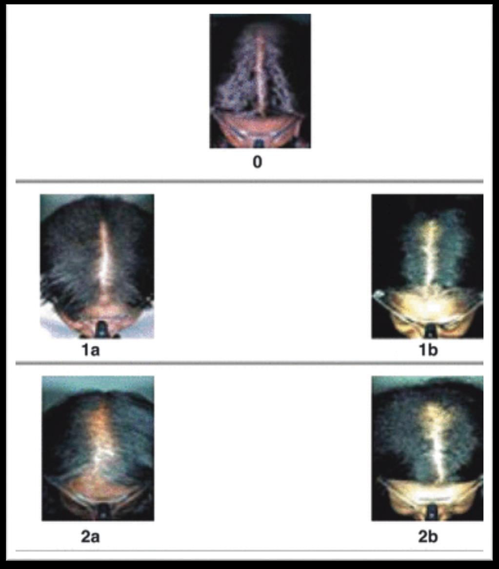 Central Scalp Alopecia