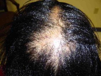 Central Centrifugal Cicatricial Alopecia Recent associations Type 2 Diabetes Traction Damage Cornrows Braids/Extensions Family History Hx of tinea capitis Use of hair dyes No association Hot Combs