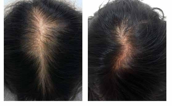 48 SKIN TECH PHARMA GROUP Main indication: Alopecia Products: XL Hair, AD daily care Hair, Revitalix Patient age/sex: 63/Female Area, pathology: scalp, alopecia Type of treatment: intradermal