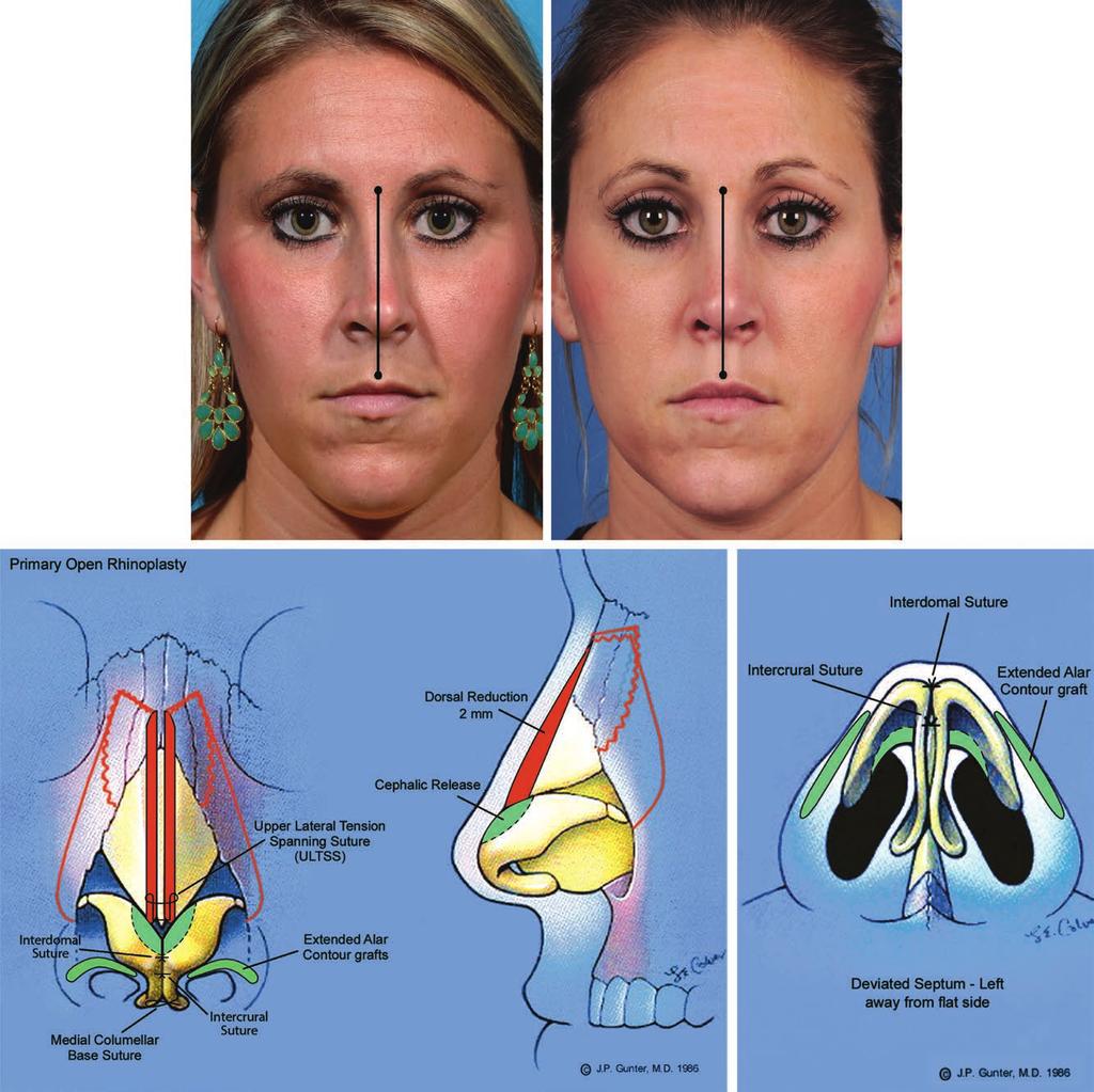 Volume 140, Number 3 Facial Asymmetry in Rhinoplasty Fig. 1. Case example. Young female patient presenting with left nasal deviation and a right wide and short facial asymmetry.