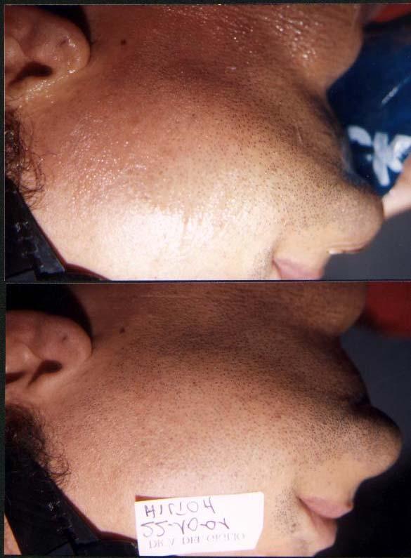 Follow-up observation During the first week after the treatment, no significant hair reduction was observed, which was the expected response, due to the time it takes for the hair to fall out of the