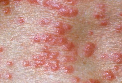 com/skin-problems-and-treatments/ss/slideshow-scabies-overview Think Scabies Crusted Scabies