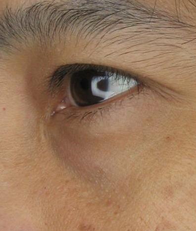 for lower eyelid rejuvenation especially radiofrequency which