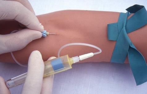 The Venipuncture 1) Attach the appropriate needle to the hub by removing the plastic cap over the small end of the needle and inserting into the hub, twisting it tight 2) Remove the plastic cap over