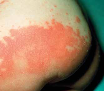 Clinical Review DATE OF PUBLICATION: OCTOBER 2017 NAPPY RASH: FROM TREATMENT TO PROTECTION Nappy rash is the most common dermatological condition during infancy.