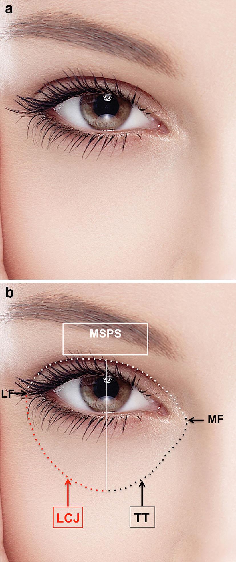 b Fig. 1 a Photograph of the peri-ocular area of a young attractive female model. The eye fissure presents a jaguar-like lateral upward slanting. The sclera presents a snow- white color.