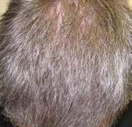 The medical team places 1-hair grafts in the frontal hairline for a