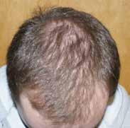 Jeff Waesche, MD, a hair transplant surgeon, says, Patients who use LLLT after a hair transplant notice quicker healing and regrowth of their