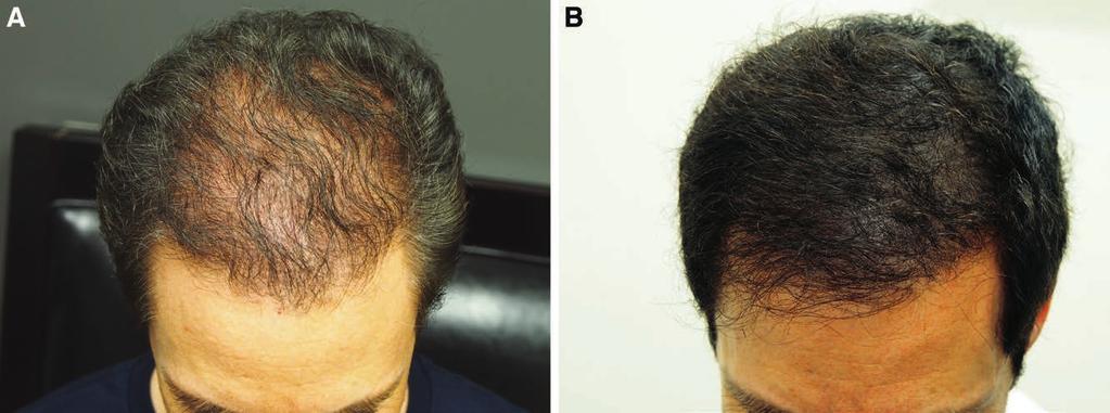 3 5 The use of SMP can create a fuller looking head of hair; even when the actual hair densities are low. Merging these two modalities has been performed in our practice over the past half-decade.