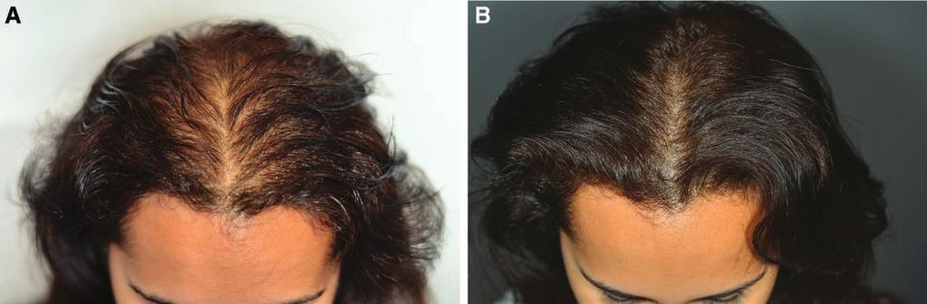 Rassman et al. Follicular Unit Extraction and Scalp Micropigmentation Fig. 3. A forty-year-old woman with thinning hair with a diagnosis of diffuse alopecia, probably genetic in origin.