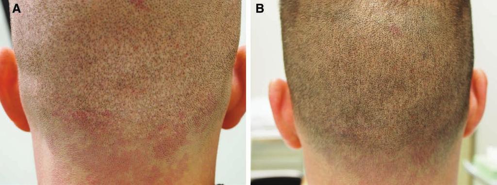 Rassman et al. Follicular Unit Extraction and Scalp Micropigmentation Fig. 5. Patient who wanted to have a very short haircut but had a moth-eaten appearance after FUE.