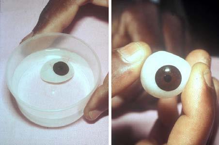 15. Management of an Eye Prosthesis or Conformer (3) Method To insert the prosthesis or conformer It will help if the patient looks downwards Clean the eyelids using cotton buds or gauze moistened in