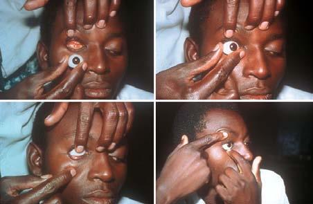16. Management of an Eye Prosthesis or Conformer (4) Top left picture: Using the other hand, gently lift the upper eyelid with a fingertip Top right picture: Insert the upper part of the prosthesis