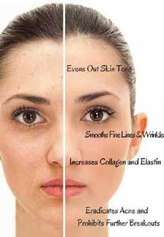 skin shedding and re-growth Reduce the appearance of brown marks, freckles and pigmentation, age and liver spots, acne, scaly patches and rough skin (keratoses) MICROBLADING Microblading is a way of