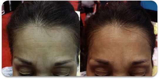 Treatment of frown lines on the forehead Subject: woman, 58yrs, Fitzpatrick 3. Object: frown lines.