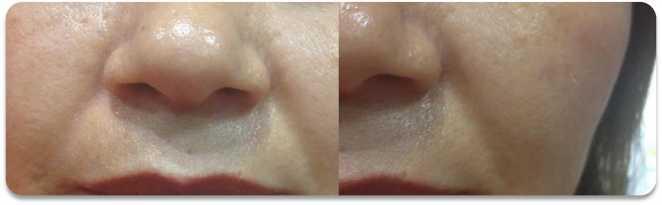 Before Before After After Results visible after 1 treatment only.