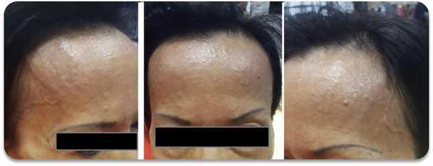 Treatment of forehead Subject: woman, 72yrs, Fitzpatrick 2.