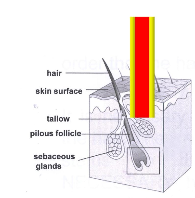 2. The mechanism of hair removal The mechanism of laser epilation involves the absorption of laser light by the pigment melanin.