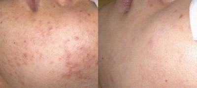 CONTINUES WAVE MODE- ACNE TREATMENT Apply the Indocyanine green on the treatment area Do not