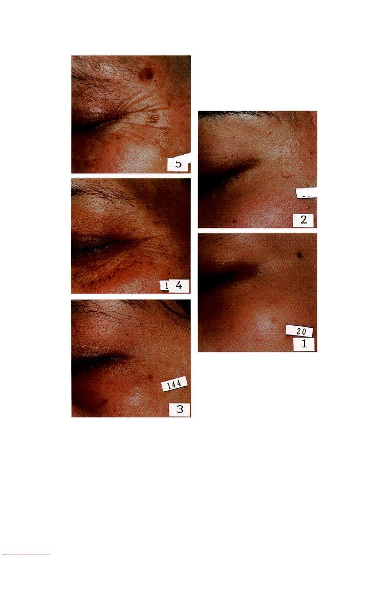 ASSESSMENT OF FACIAL WRINKLES 129 2 Figure 1. Five-grade photographic scale used to evaluate wrinkles at the outer eye corners.