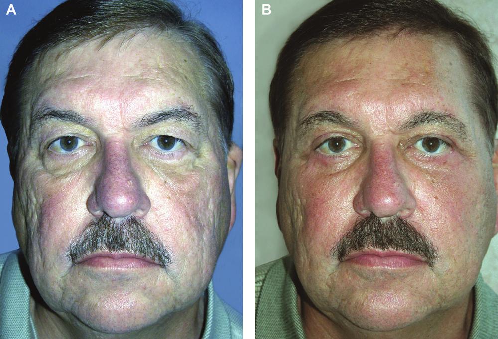 244 Aesthetic Surgery Journal 34(2) Figure 8. (A) This 63-year-old man presented with puffy lower eyelids and moderate festoons, with Hertel measurement of 17 mm.