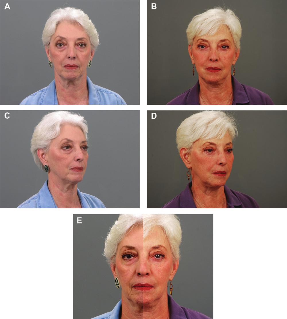 Kpodzo et al 241 Figure 5. (A, C) This 64-year-old woman presented with an aging appearance of face and eyelids, including moderate malar mounds and prominent eyes, with Hertel measurement of 18 mm.