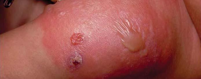 Cellulitis vs venous eczema About cellulitis Prevent misdiagnosis Differential diagnosis