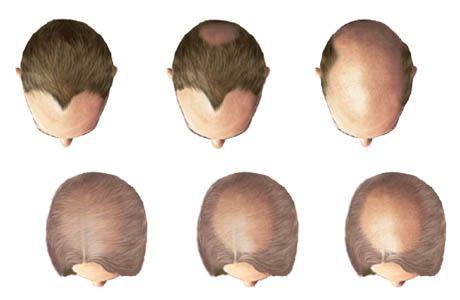 23 P a g e causing hair loss. 40% of the men have significant hair loss by the age of 40 and 60% by the age of 65.