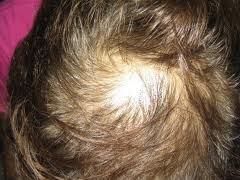 29 P a g e ANDROGENETIC ALOPECIA A ndrogenetic alopecia or androgenic alopecia is the most common hair loss