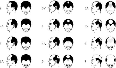 It is also commonly known as male pattern baldness due to the fact that hair loss follows a definite pattern.
