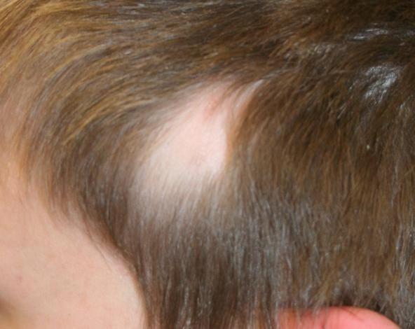 30 P a g e Androgenetic Alopecia occurs due to genetic sensitivity of hair follicles to DHT. The only way to prevent Androgenetic Alopecia is to eliminate DHT from the scalp.