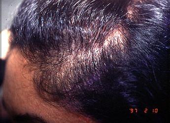 32 P a g e Hair loss caused by Telogen Effluvium is reversible and the patient usually regains lost hair in six to twelve months.