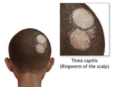 34 P a g e TINEA CAPITIS Tinea Capitis, also known as ringworm of the hair, herpes tonsurans and tinea tonsurans, is a fungal infection that is caused by a group of fungus called Dermatophytes.