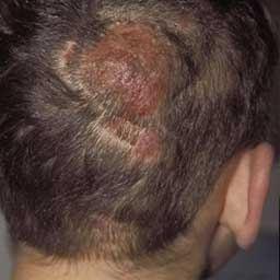 35 P a g e TREATMENTS: Tinea cpitis is generally treated with oral medicines. It is usually advised to use ketoconazole shampoo.