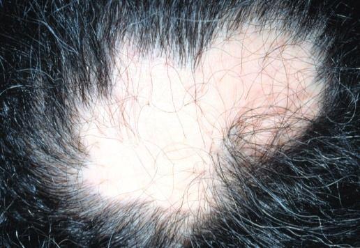 37 P a g e SCARRING ALOPECIA S carring Alopecia is a name given to diseases characterized by permanent hair loss. It is also known as cicatricial alopecia ).