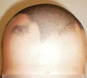 Hair Loss Treatments Results Hair Loss Treatments with Soft Laser Bergmann Kord s non surgical