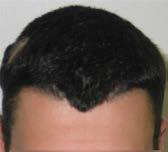 in order to delay the beginning of hair loss and strengthen weakened hair.