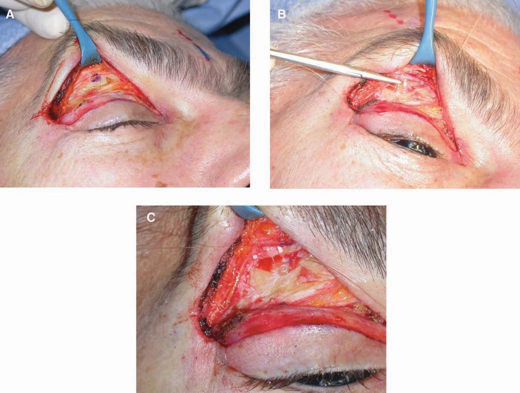 166 Aesthetic Surgery Journal 31(2) Figure 4.