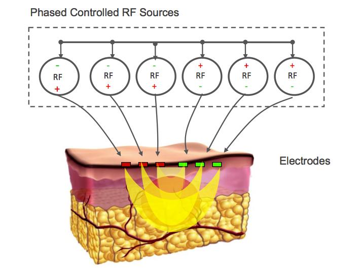 Figure 1: Rt. 3DEEP, Multisource Radiofrequency technology in which each electrode phase controlled. Lt. The NEWA home use wrinkle reduction device (EndyMed Ltd., Cesarea, Israel).