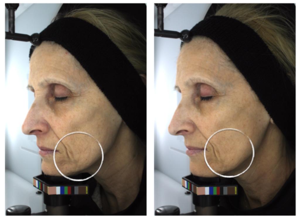 Figure 3: Lt. Pre-treatment (baseline). Rt. 12W follow-up. Significant lift effect of the lower face, texture improvement and wrinkle reduction.