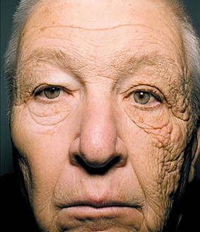 Drivers & Truckers Truck drivers develop Skin Cancer on left