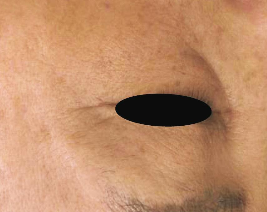 s the orbicularis oculi muscle contracts by various facial expressions and movements, folding or wrinkling of the overlying skin occurs intensifying the UVinduced photodamage.