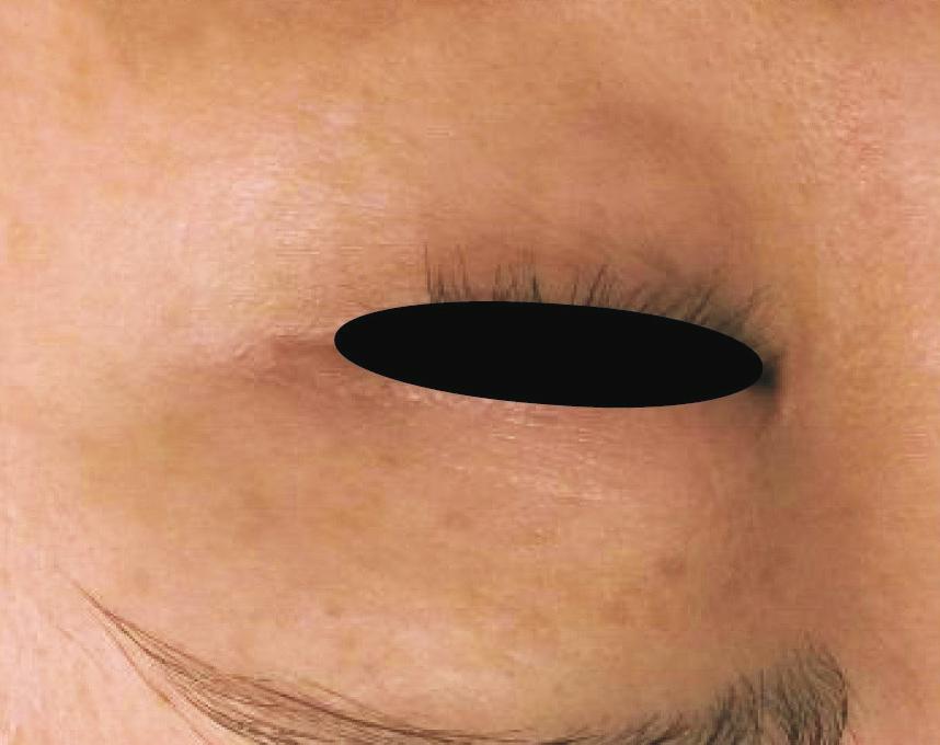 on the corners with skin thinning (Fig. 2).